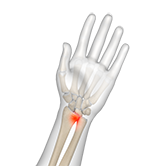 Distal Radioulnar Joint (DRUJ) Arthritis Image