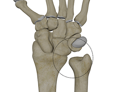 Distal Radioulnar Joint (DRUJ) Instability - Educational Picture