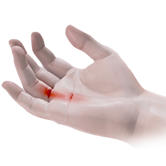 Dupuytren's Contracture Image