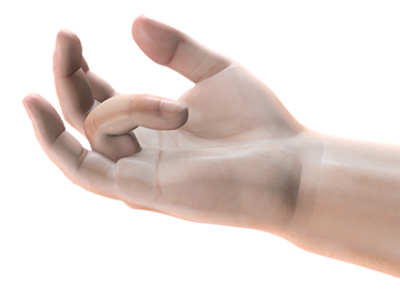 Dupuytren's Contracture - Educational Picture