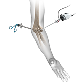 Elbow Arthroscopy Image