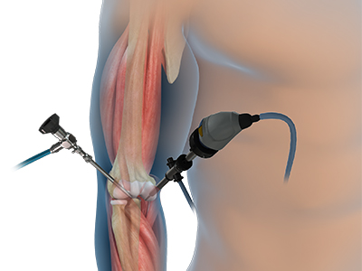 Elbow Arthroscopy - Educational Picture