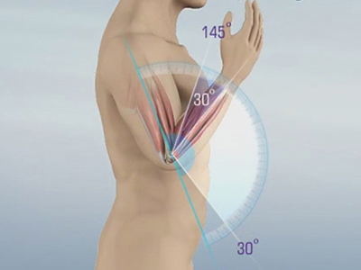 Elbow Contracture - Educational Picture