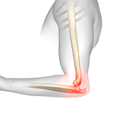 Elbow Dislocation Image