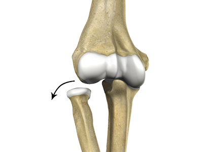 Elbow Injuries - Educational Picture