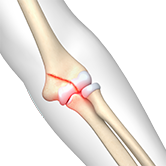 Elbow Fractures Image