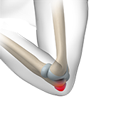 Elbow (Olecranon) Bursitis Image