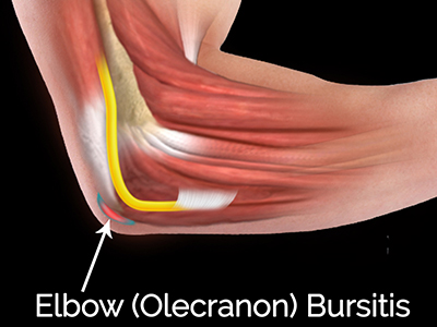 Elbow (Olecranon) Bursitis - Educational Picture