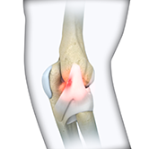 Elbow Sprain Image