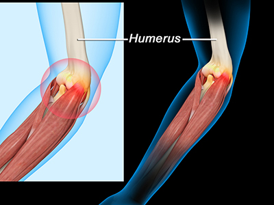 Elbow Sprain - Educational Picture