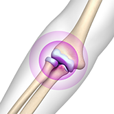 Elbow Stiffness Image