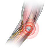 Elbow Stiffness Surgery Image