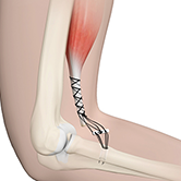 Elbow Tendon and Ligament Repair Image