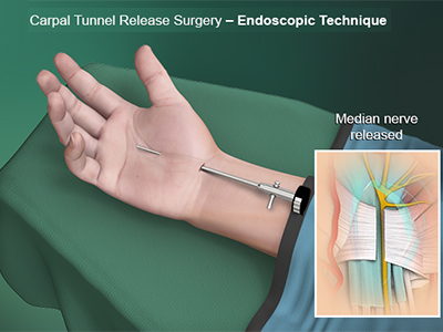 Endoscopic Carpal Tunnel Release - Educational Picture