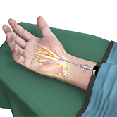 Endoscopic Carpal Tunnel Release Image