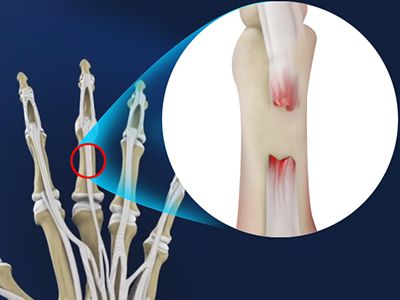 Extensor Tendon Injuries - Educational Picture
