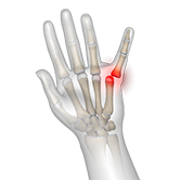Finger Dislocation Image