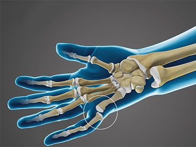 Finger Dislocation - Educational Picture
