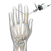 Finger Joint Arthroscopy Image