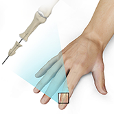 Finger Joint Fusion Image