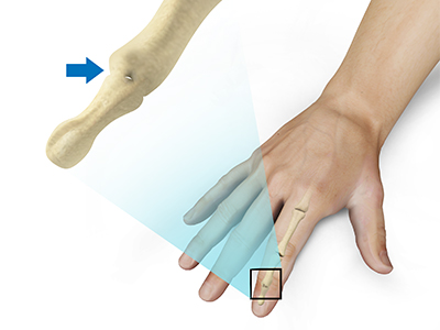 Finger Joint Fusion - Educational Picture