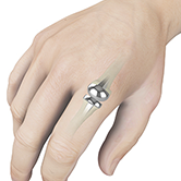 Finger Joint Implant Image
