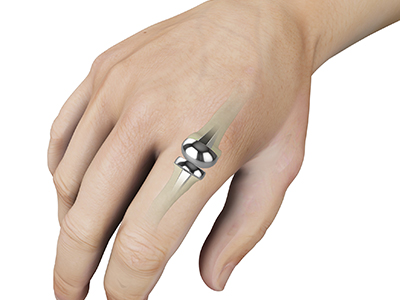 Finger Joint Implant - Educational Picture