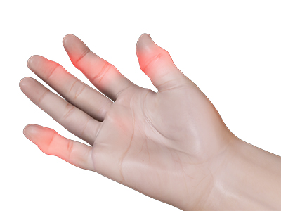 Finger & Thumb Sprain - Educational Picture