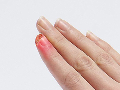 Fingertip Injuries - Educational Picture
