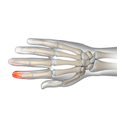 Fingertip Injuries Image