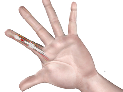 Flexor Tendon Injuries - Educational Picture
