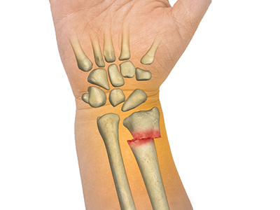 Forearm Fractures in Children - Educational Picture