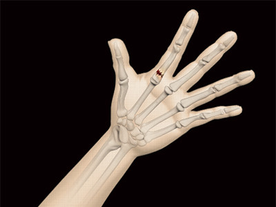 Fracture of the Finger - Educational Picture