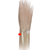 Fracture Malunion Image