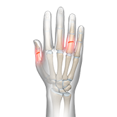 Fracture of the Finger Image
