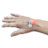 Ganglion (Cyst) of the Wrist Image