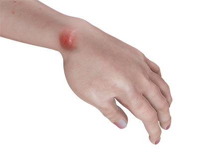 Ganglion (Cyst) of the Wrist - Educational Picture