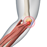 Golfer's Elbow Image