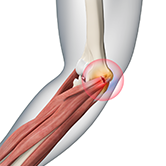 Golfer's Elbow Surgery Image