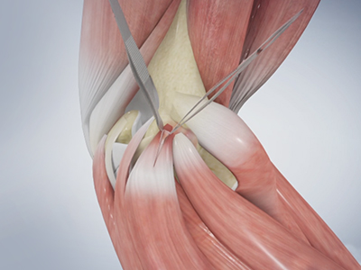 Golfer's Elbow - Educational Picture