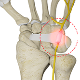 Guyon's Canal Syndrome Image