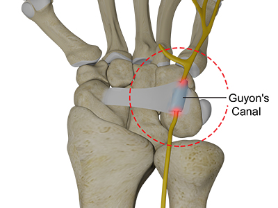 Guyon's Canal Syndrome - Educational Picture