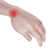 Hand Infections Image