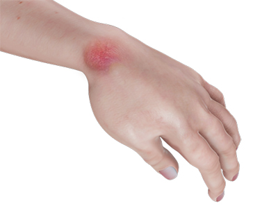 Hand Infections - Educational Picture