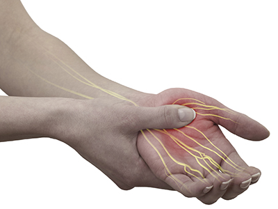 Hand Numbness - Educational Picture