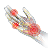 Industrial Hand Trauma Image