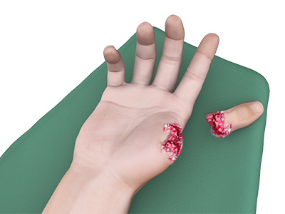 Industrial Hand Trauma - Educational Picture