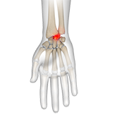 Kienbock's Disease Image