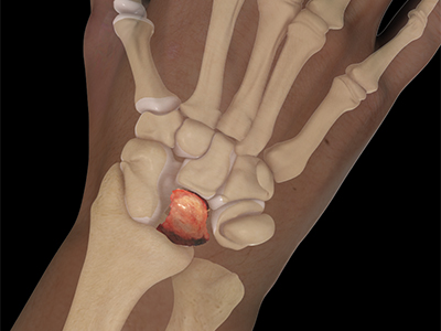 Kienbock's Disease - Educational Picture