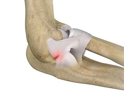 Lateral Ulnar Collateral Ligament Injuries - Educational Picture